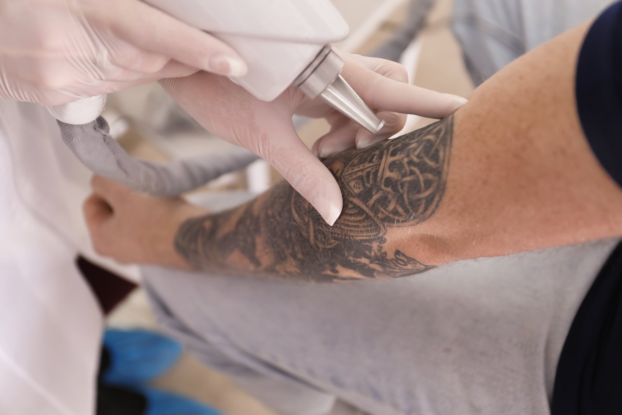 Cosmetologist with Patient and Professional Tattoo Removal Laser